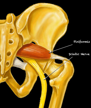 piriformis syndrome discussed using muscle picture