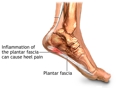 heel pain picture
