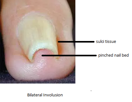 involuted toenail, description
