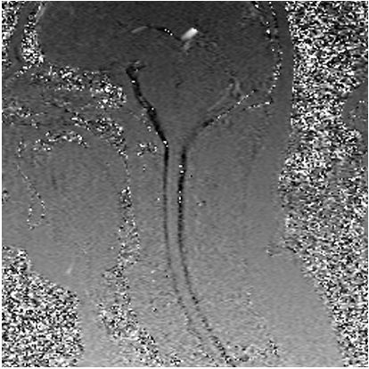 spinal fluid flow MRI