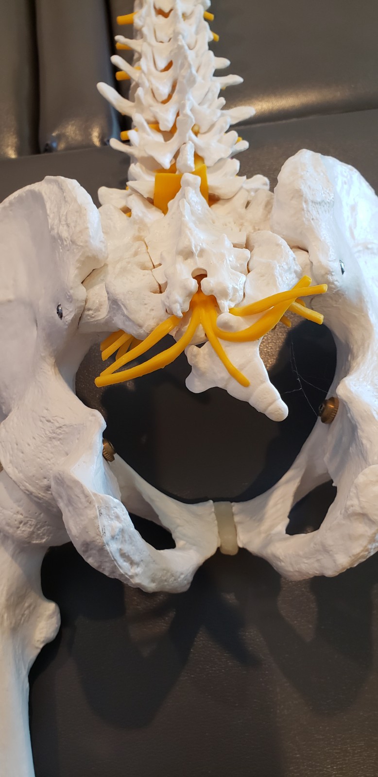 spinal model showing the tailbone or coccyx misaligned